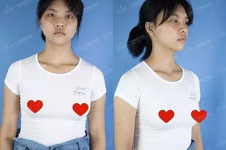 what34c罩杯的细腿精抽了200ml脂肪隆胸