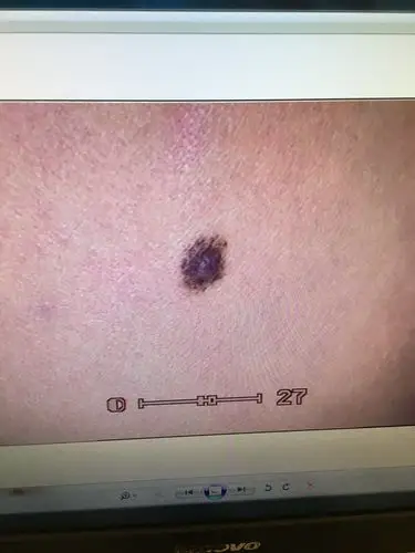 色素痣 - 好大夫在线