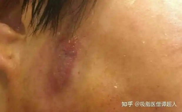 成都谭超谨防幽灵医生口中的溶脂针它的危害你知道吗