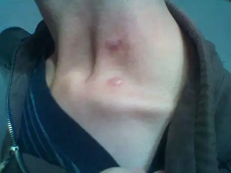 不知怎么的脖子两侧起了两片什么癣,但是又不是很痒,就是摸起来很粗糙