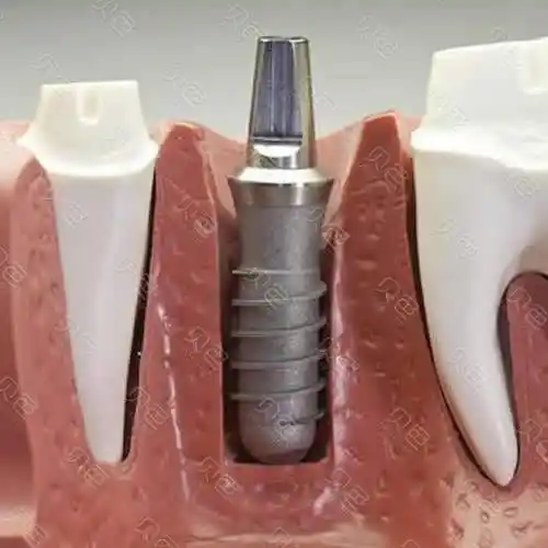 东莞种植牙收费价目表曝光这几家价格更亲民