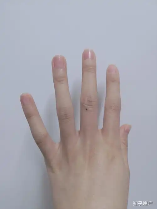 女生右手中指突然长了个小痣代表什麼? - 知乎