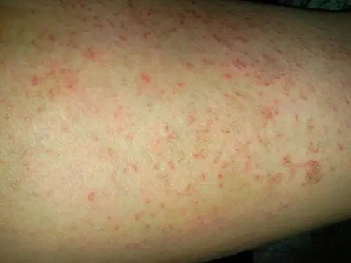 根据图片看起来像是过敏性皮炎或者湿疹一类的疾病,还是及时到皮肤科