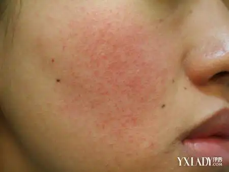 【图】角质层薄怎么修复 细数角质层受损原因