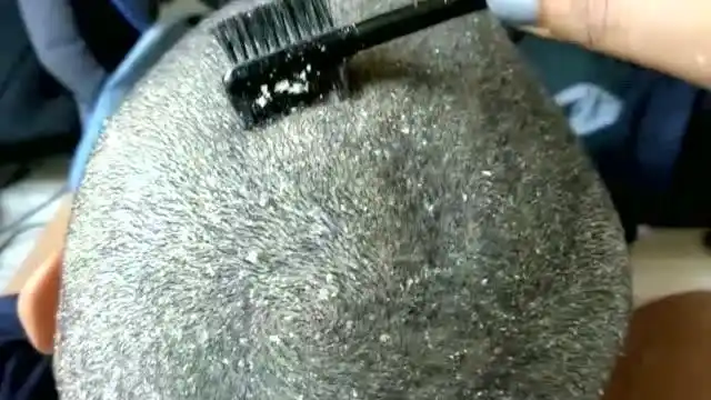 4个月没洗头,剃了头发后一堆一堆的头皮屑