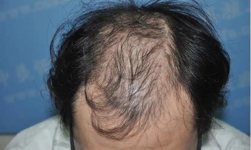 5级脱发人的植发历程和感想2012729更新