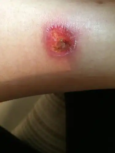 小腿烫伤了.水泡太大,后来就挑破了.