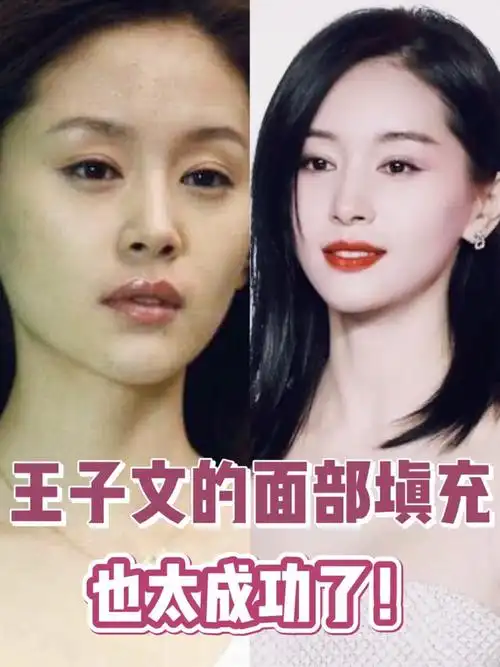 王子文的面部填充也太成功了吧7515-在饰演曲筱绡的时_圈子-新氧