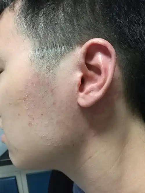 面部难辨认癣 - 好大夫在线