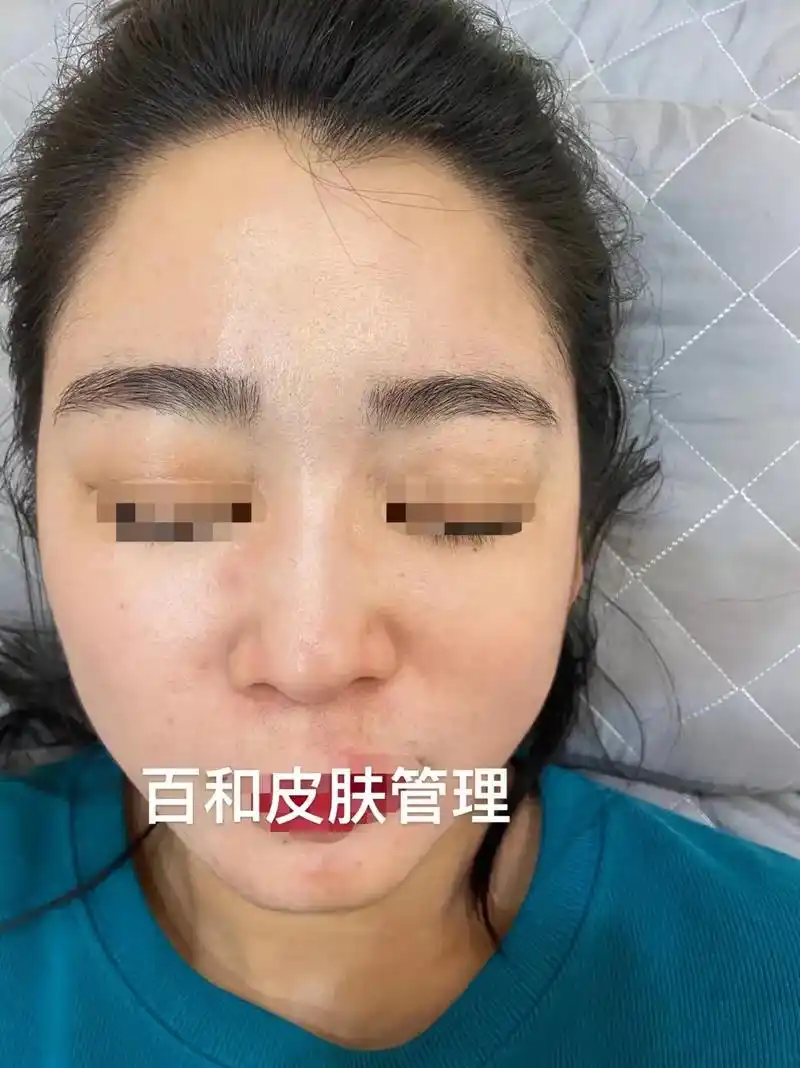 问题性皮肤管理