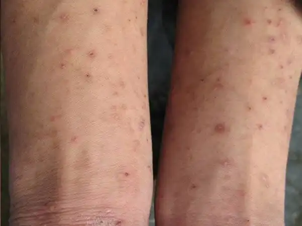 疥疮的症状图是什么样