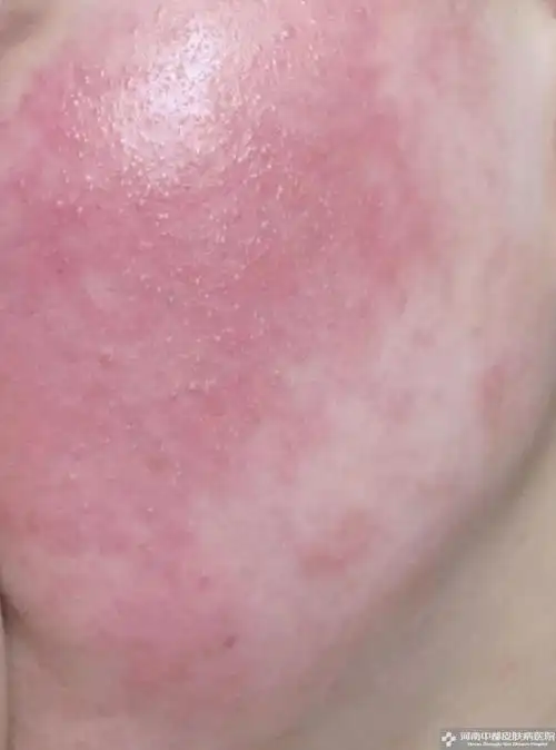 皮肤过敏又红又痒怎么办