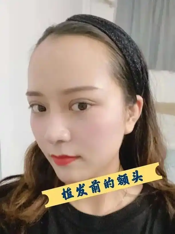 直发际线完美解决! 直发前,额头又宽又 - 抖音
