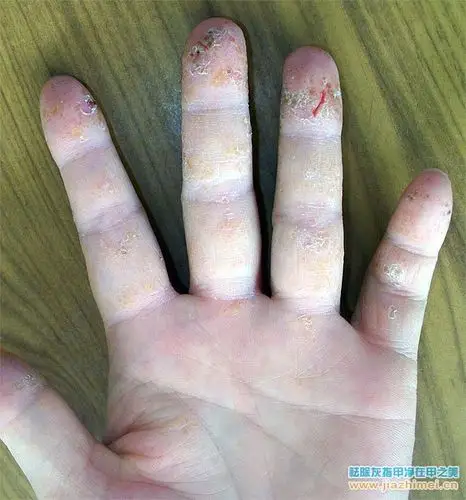 手指尖开裂起小水泡脱皮多半是染上了水泡型手癣