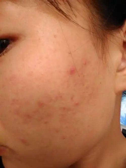 痘痘起很长时间了,大小不一,有的发红,里面有很多脏东西,痘印_皮肤科