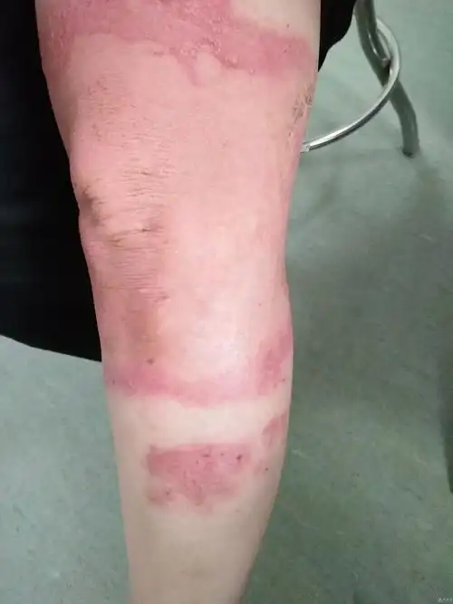 典型病例接触性皮炎