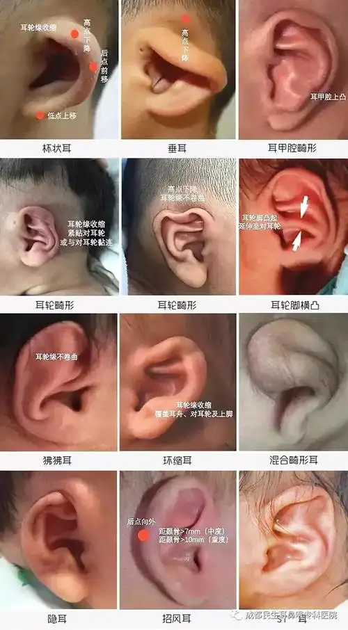 新闻频道 滚动  耳廓畸形不仅仅会影响美观,而且随着宝宝的成长会产生