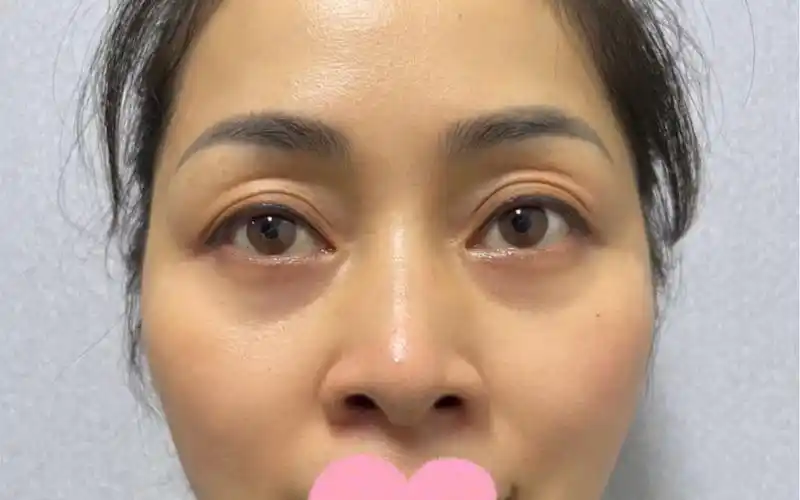 泪沟凹陷熊猫眼脂肪填充恢复年轻态