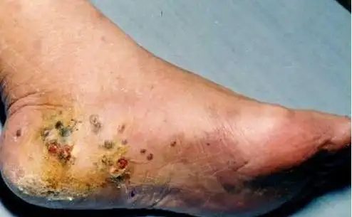 卡波西肉瘤是一种血管内皮细胞起源的肿瘤,多数卡波西肉瘤的组织内