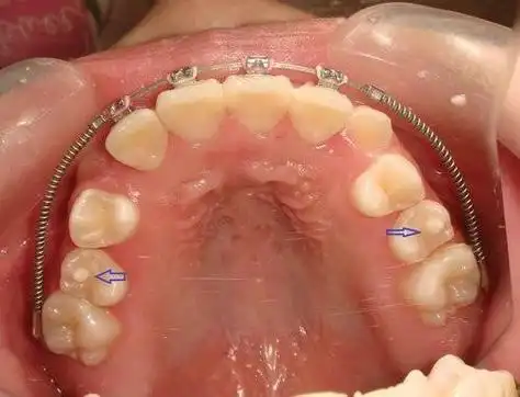 牙齿上多长了个小尖尖,能不能直接磨掉?