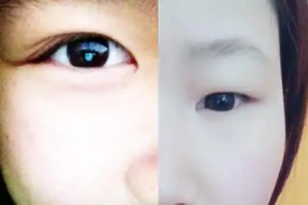 图内双和单眼皮的区别图让你成功区分它们