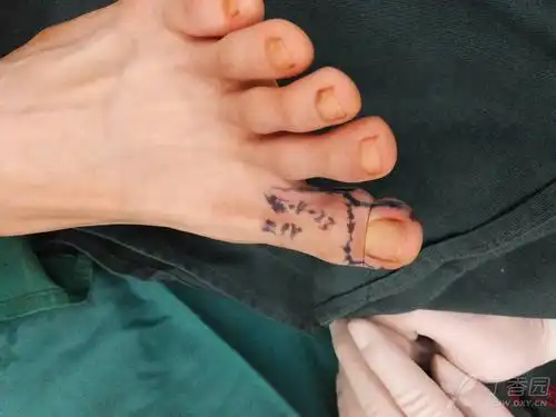 【讨论】保留五个足趾的拇指全型再造