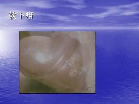 硬下疳与软下疳_软下疳_软下疳