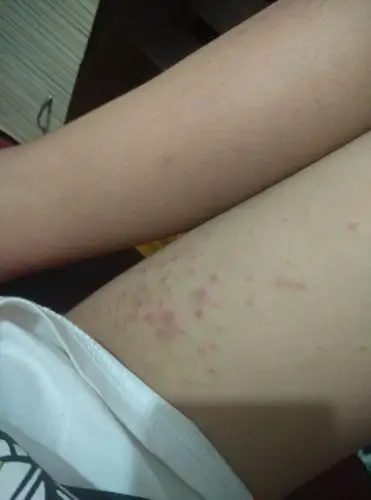 我的大腿上长了这种东西 不知道是什么 两个多月了 有时痒有时不痒