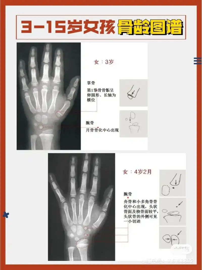 3-15岁女孩 详细骨龄对照图谱 3-15岁女孩 详细骨龄对照图谱