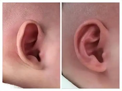宝宝的耳朵形态正常吗?