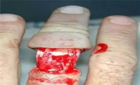 戴戒指打保龄球骨肉分离惨不忍睹