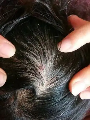 头皮毛囊炎反反复复会影响植发吗