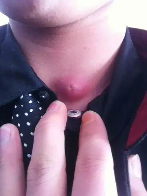 3270lv12 擅长:医疗健康 向ta提问私信ta  展开全部 他患的是毛囊炎