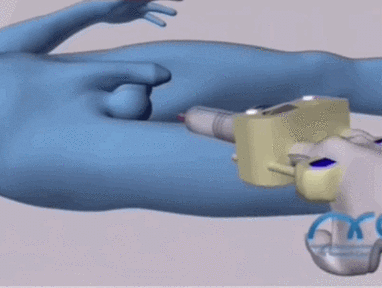 给一个术前考虑是梗阻性无精子症的患者做诊断性tesa(睾丸穿刺取精)