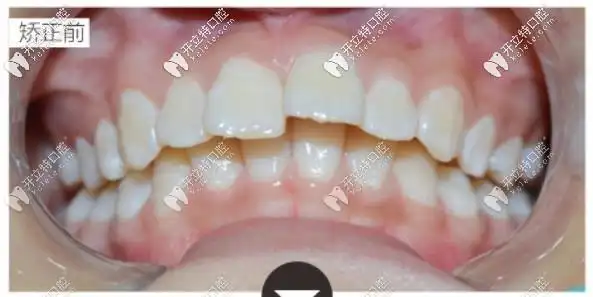 来看看上牙包下牙的我是如何矫正恢复正常咬合的吧!