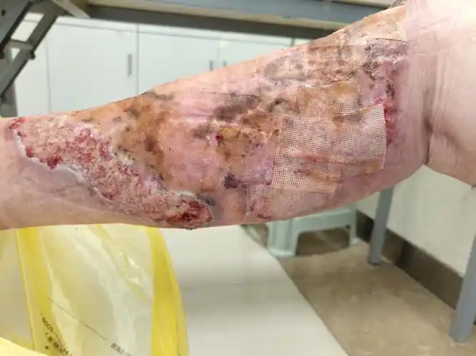 11.14陆瑞红右下肢皮肤溃疡第一次门诊换药记 - 美篇