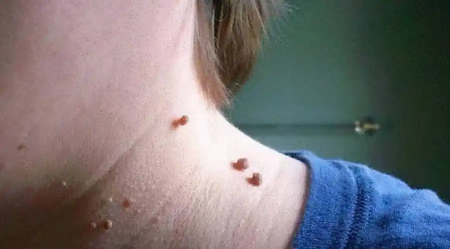 疣怎么治疗疣长什么样子图片