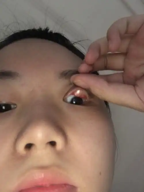 请问眼皮上这是什么啊,眼睛摸起来凹凸不平,今天翻眼皮下起了,翻起