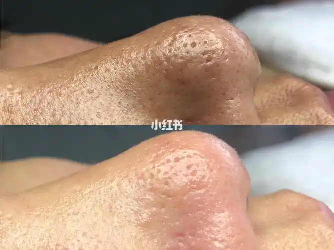 【问题】:毛孔被堵塞,毛孔粗大有黑头怎么改善?