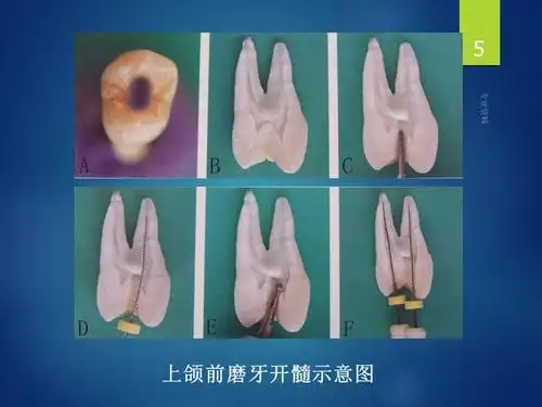 根管治疗标准规范专家指导