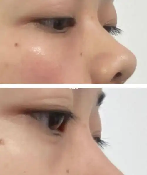 在办公室自拍的直男角度但是嗨体填充完即刻的效果是好的胶原蛋白泪沟