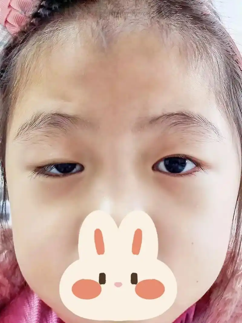 眼睛是心灵的窗户 怎能让上帝遮了帘.孩子上睑下垂 一直都是父 - 抖音