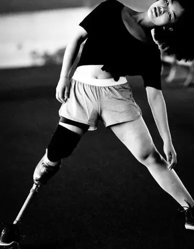 95后独腿女孩:穿短裙,露假肢,走在大街会怎样?