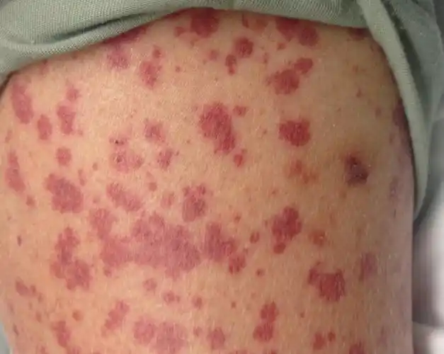 图文盘点肢端分布的血管性皮肤病