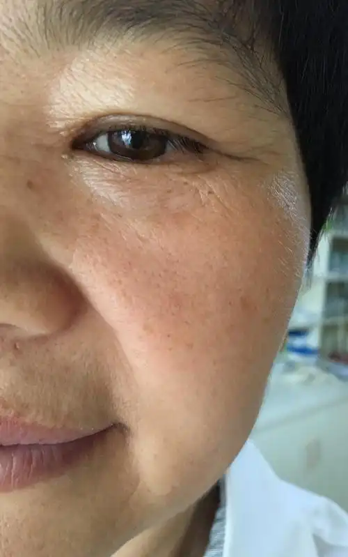 颜面浮肿2天原创