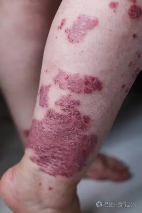特写过敏性皮疹湿疹皮肤的病人特应性皮炎症状皮肤细节质地真菌皮肤