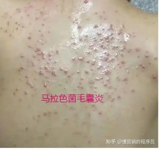 送你一份马拉色菌毛囊炎根治的方案