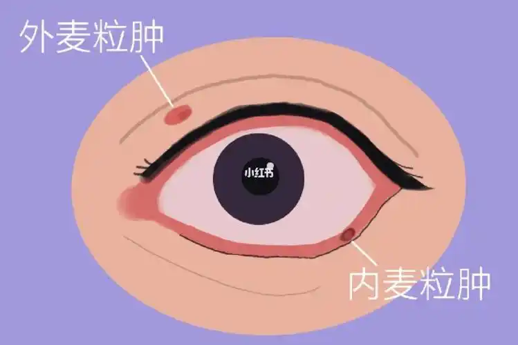 麦粒肿