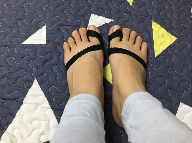 女生脚趾拇外翻是什么样体验
