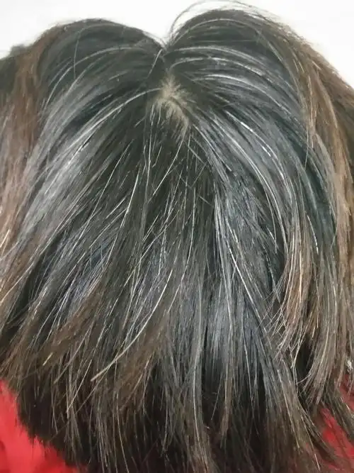 17岁,男,少白头,,已经有5年时间了了